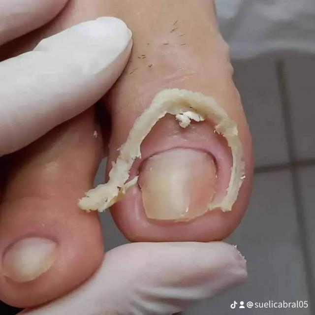 Podologia tratamento dos pés